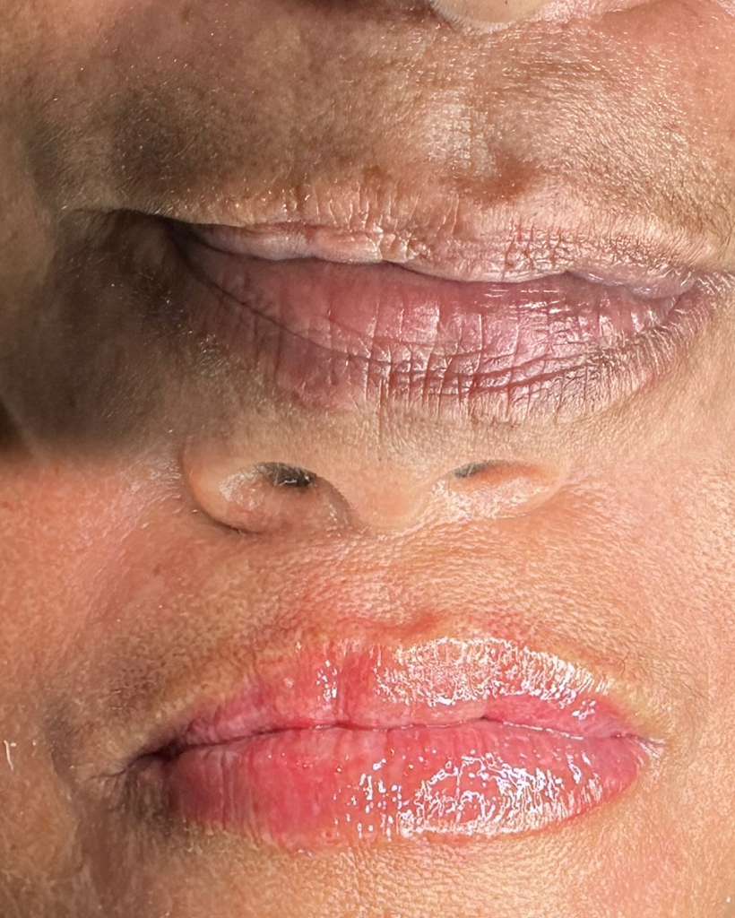 NEUTRALIZACION DE LABIOS